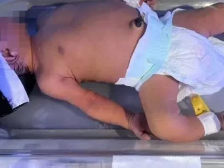 Bất đồng nhóm máu với mẹ, bé sơ sinh bị biến chứng nặng