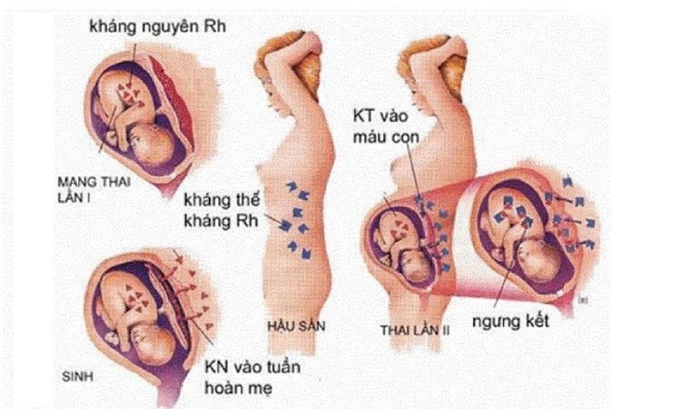 Bất Đồng Nhóm Máu