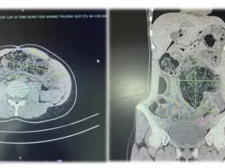 Phú Thọ: Người phụ nữ đi viện cấp cứu vì ăn quá nhiều mít mật