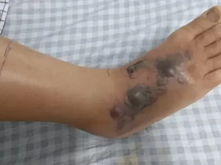 Phú Thọ: Rắn hổ mang ẩn nấp trong gầm tủ cắn vào chân người dân