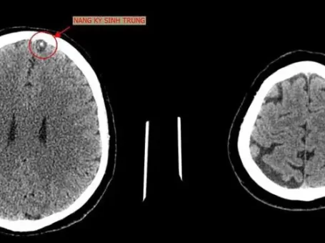 Sán làm tổ trong não người đàn ông ở Phú Thọ thường xuyên ăn gỏi cá