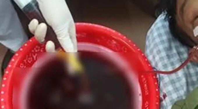 Người đàn ông ở Phú Thọ nôn ra 1 lít máu vì thường xuyên uống rượu