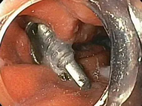 Phú Thọ: Cấp cứu thành công bé trai nuốt phải cây đinh vít nhọn