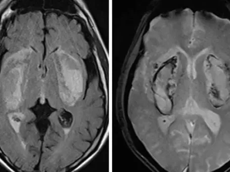 Cồn giả pha nước – Cảnh báo nguy cơ ngộ độc nặng khi uống phải