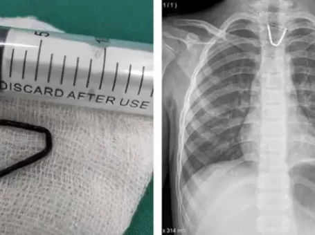 Dị vật được lấy ra và hình ảnh chụp Xquang dị vật mắc trong thực quản của bệnh nhi.